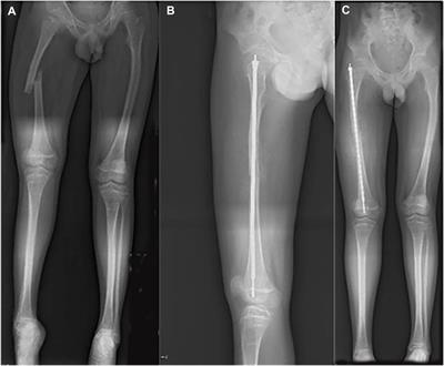 Perthes Disease in a Child With Osteogenesis Imperfecta From a Rare Genetic Variant: A Case Report